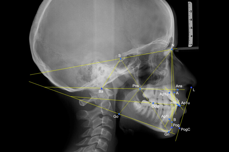 Che cos’è la cefalometria e come viene usata in ortodonzia?