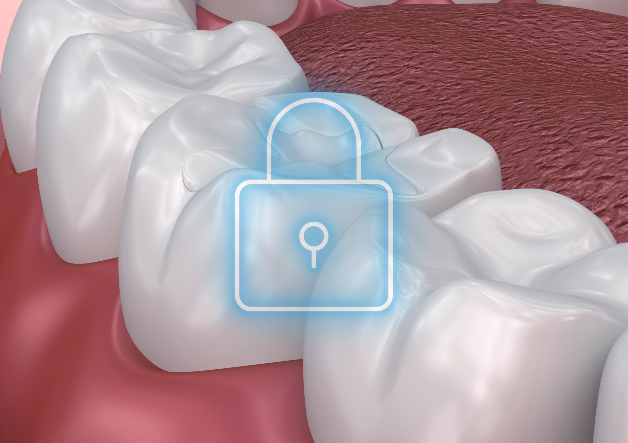 Che cosa sono le Sigillature Dentali e a chi sono consigliate?
