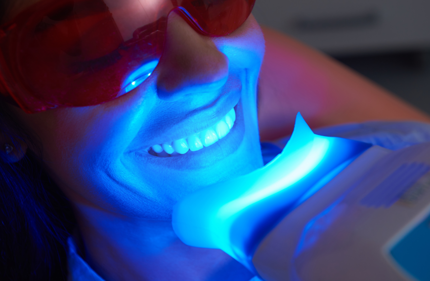A partire da quale età si può fare lo sbiancamento dentale?