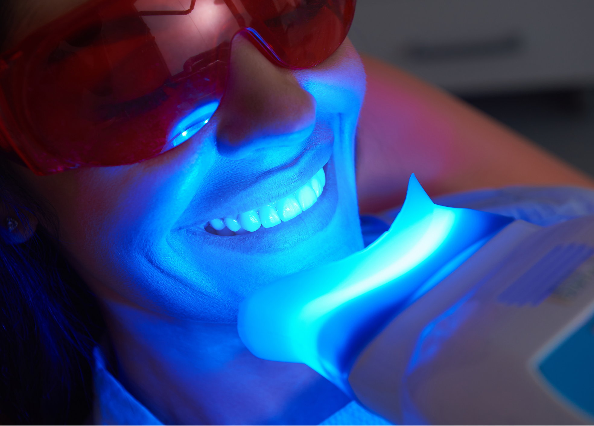 A partire da quale età si può fare lo sbiancamento dentale?