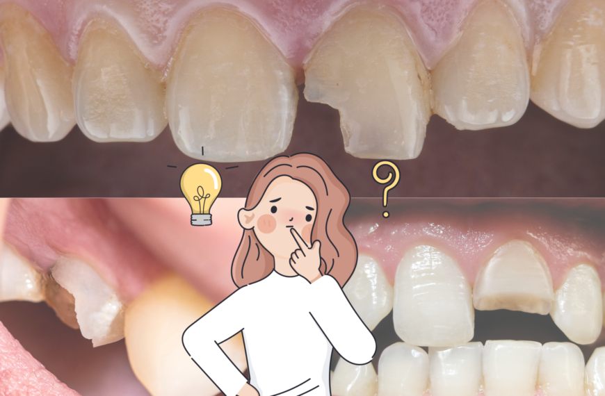 Qual è la differenza tra una frattura dentale e una scheggiatura?