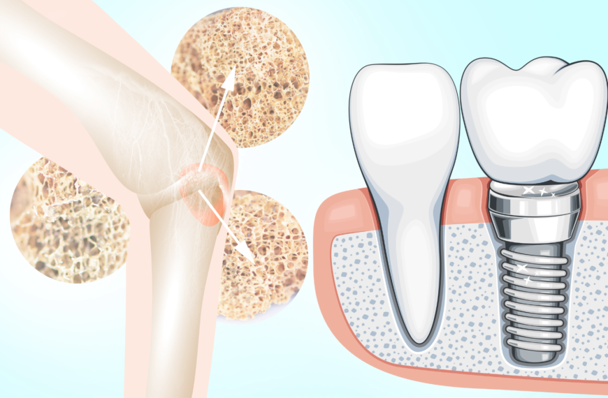 Osteoporosi e Impianti Dentali: Affrontiamo le Tue Preoccupazioni!