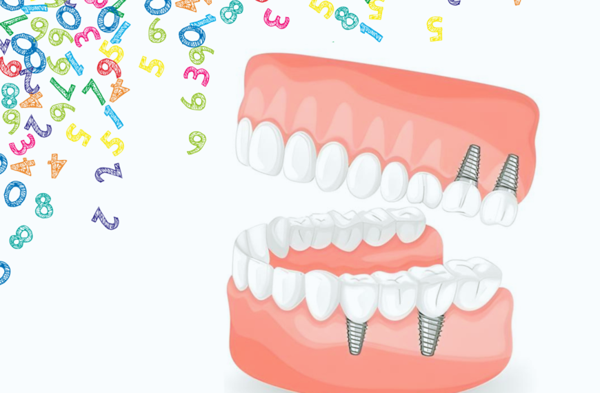 C’è un limite al numero di impianti dentali che possono essere posizionati nella mia bocca?
