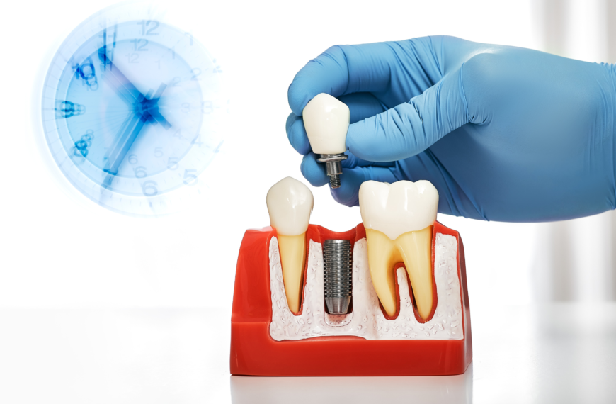 Quanto dura il processo di guarigione per un impianto dentale?