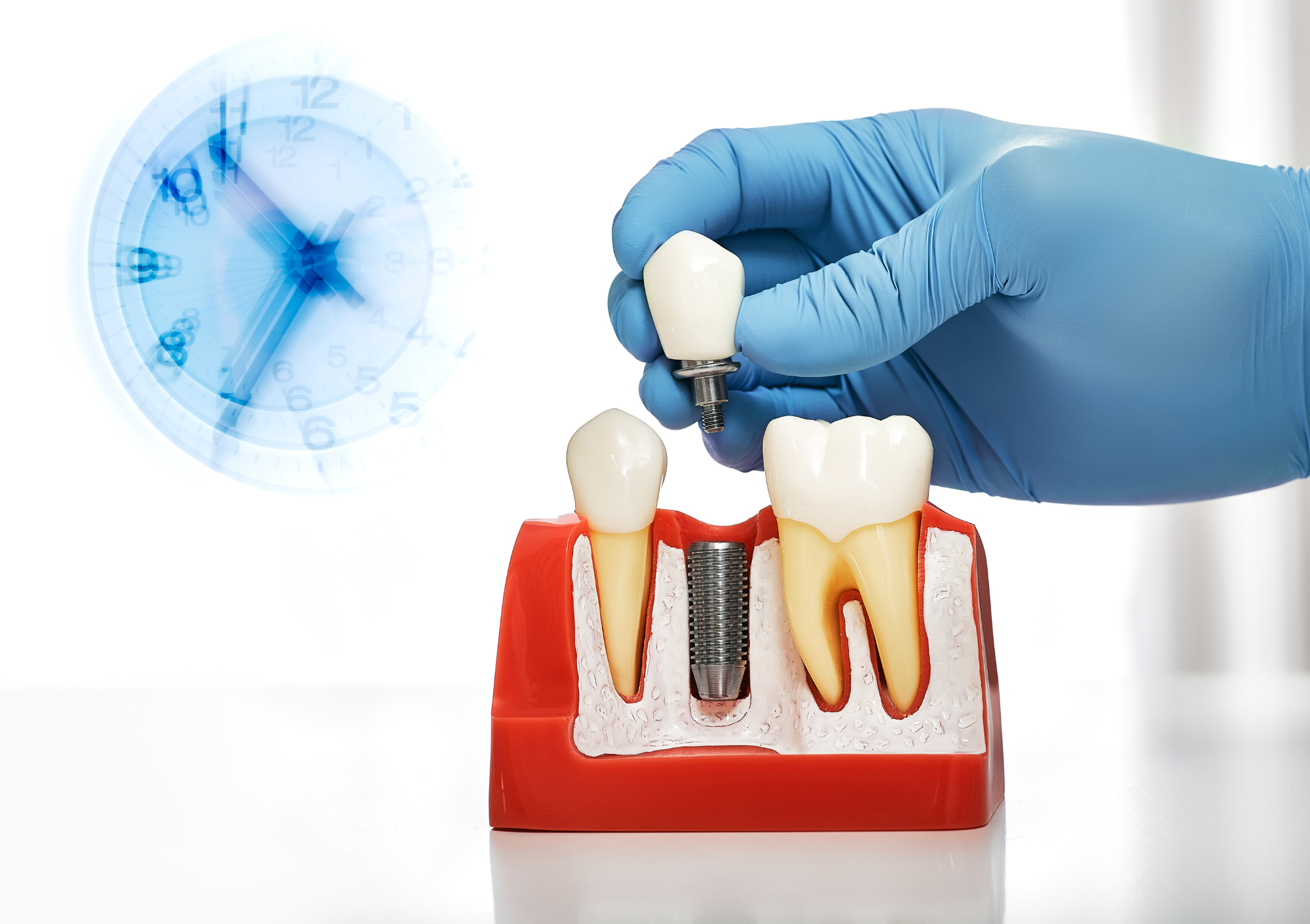 Quanto dura il processo di guarigione per un impianto dentale?