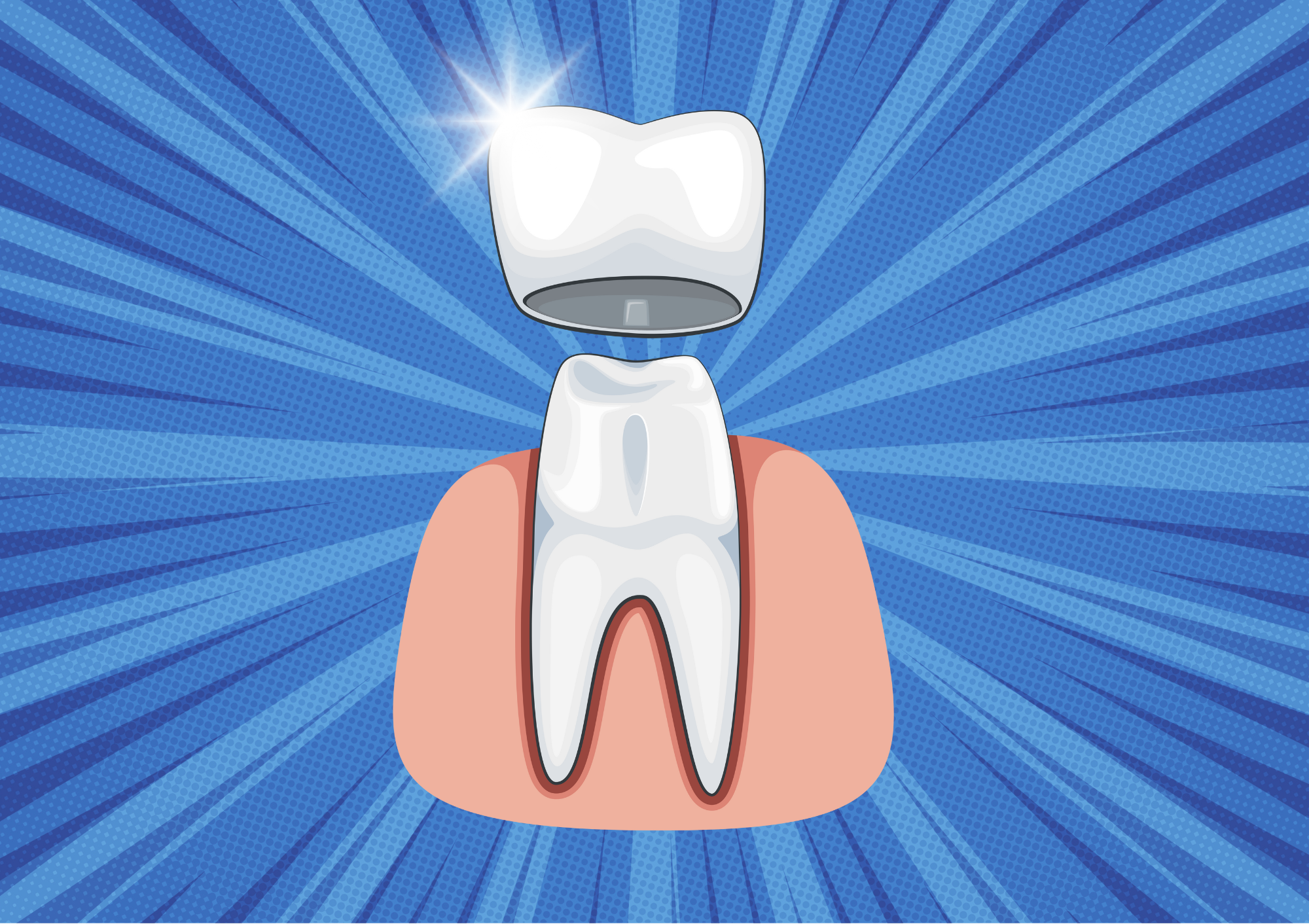 Perché e quando incapsulare un dente devitalizzato?