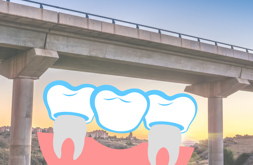 Cos’è un ponte dentale?