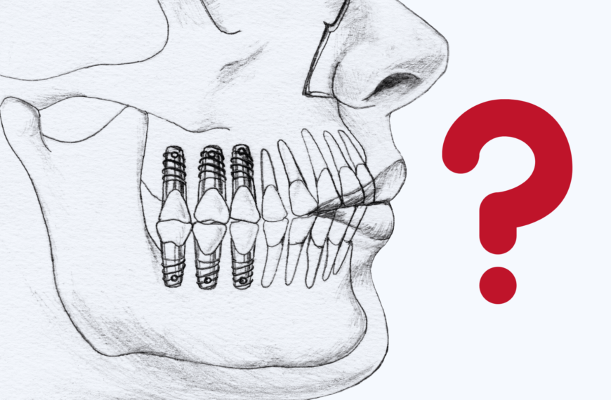 Quali Fattori Determinano il Numero di Impianti Dentali Necessari?