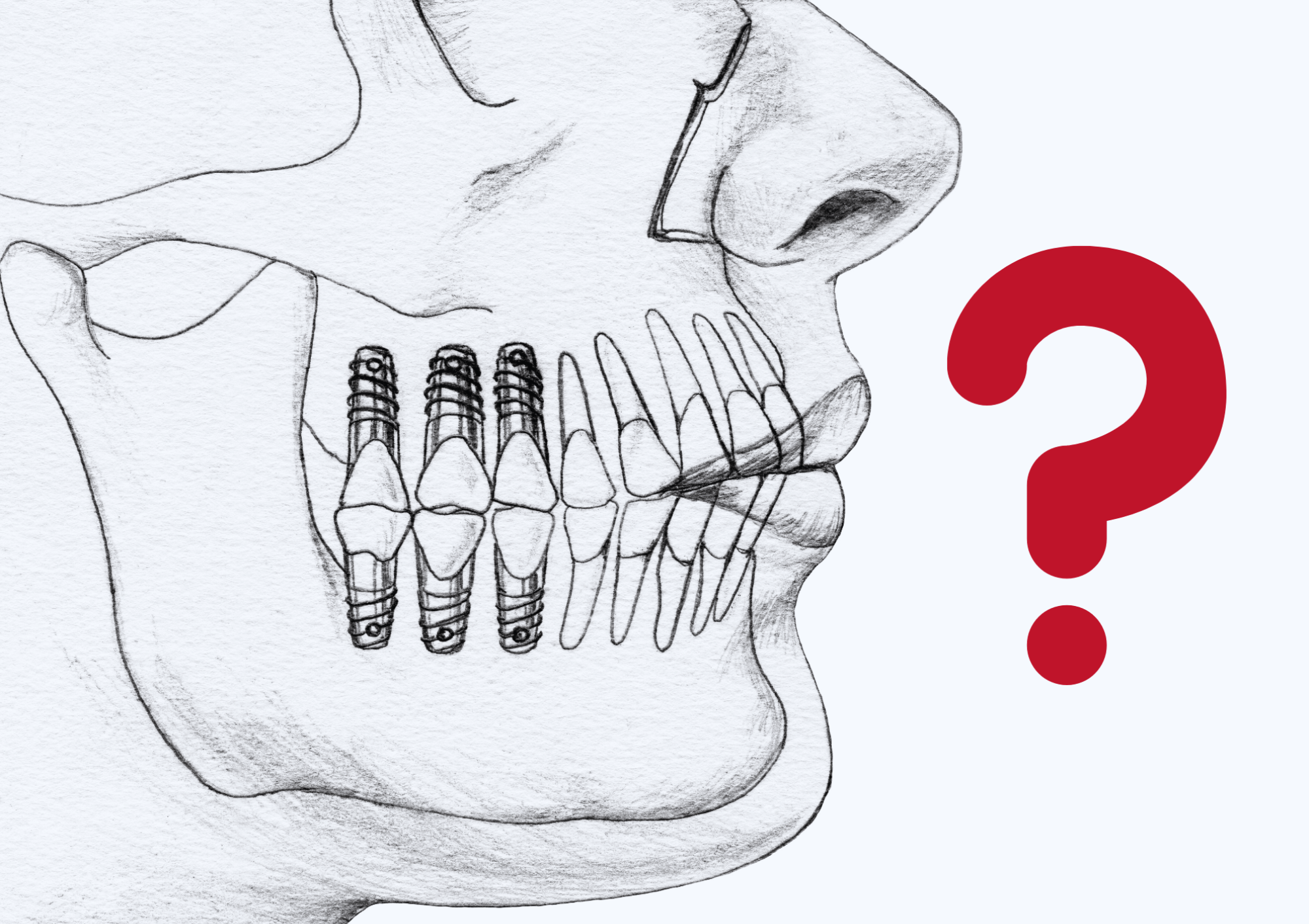 Quali Fattori Determinano il Numero di Impianti Dentali Necessari?