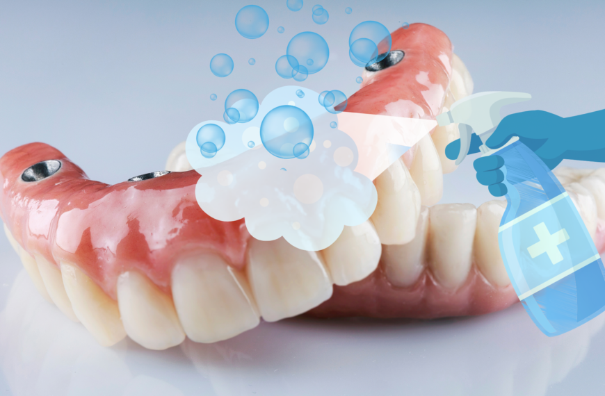 Protesi Totale su Impianti: Ogni Quanto Fare la Pulizia dal Dentista?