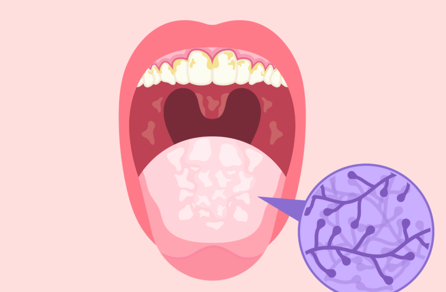 Candida orale: sintomi e trattamenti