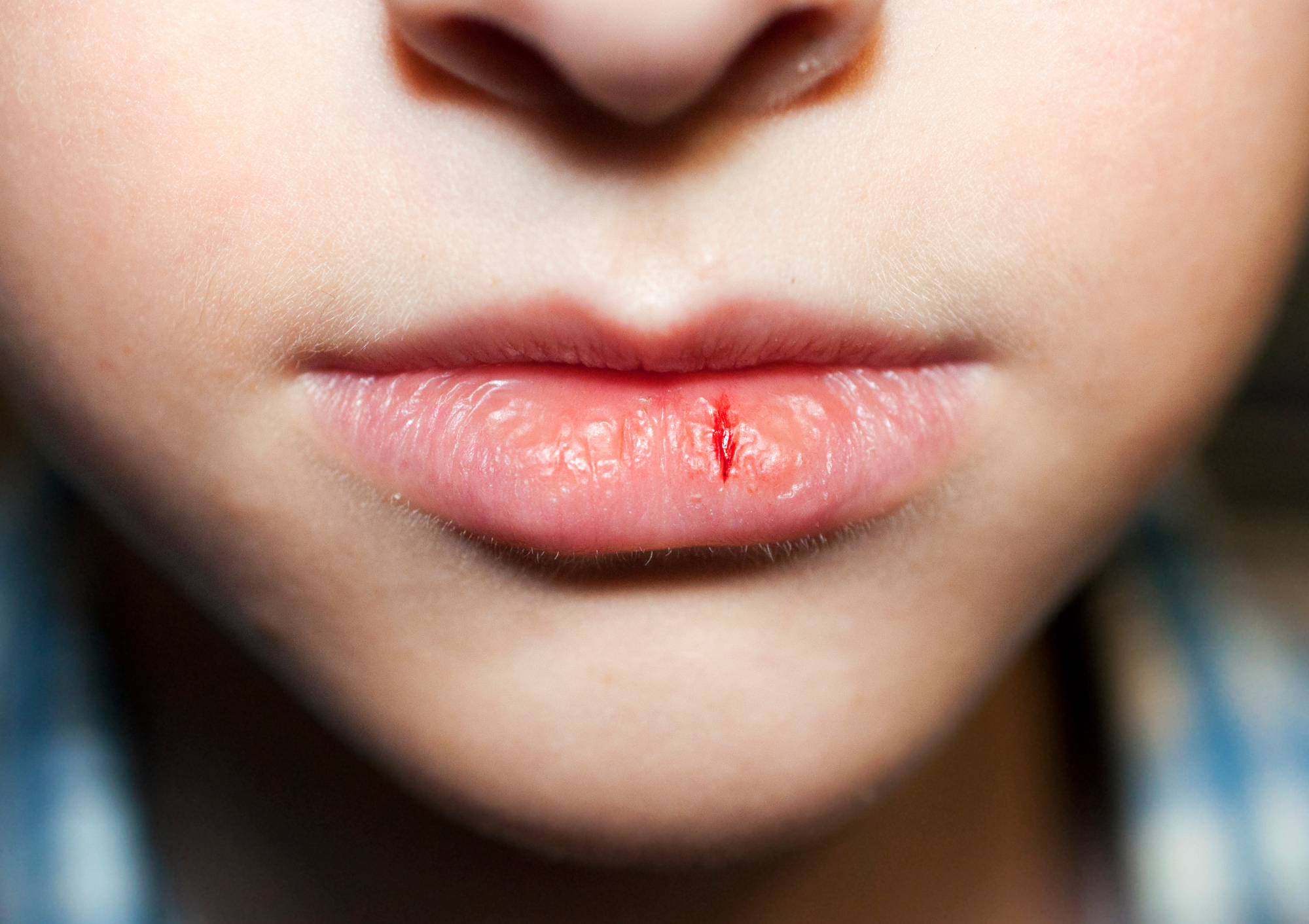 Labbra screpolate: cause e rimedi