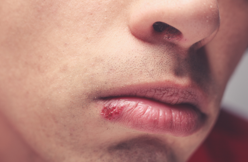 Come trattare l’herpes labiale?