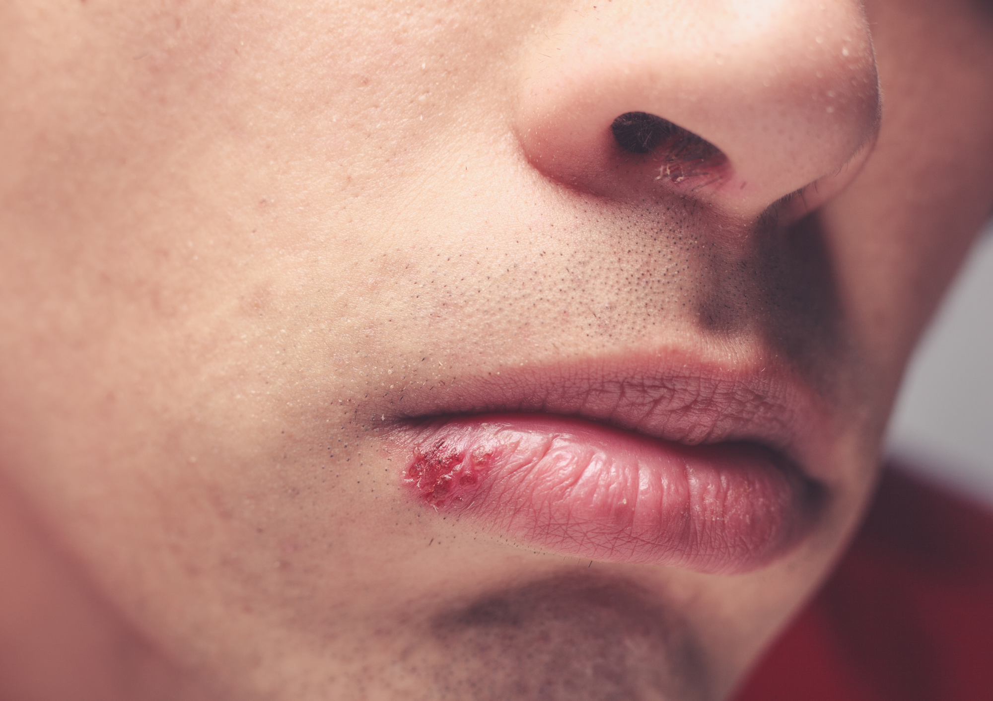 Come trattare l’herpes labiale?