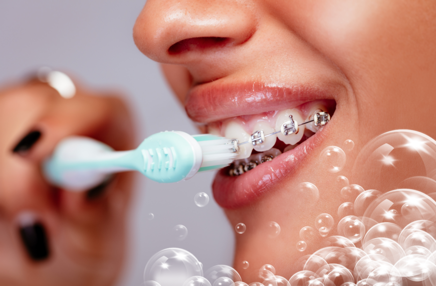 Come si lavano i denti con l’apparecchio fisso?