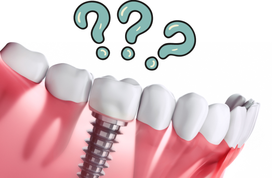 Cos’è un impianto dentale e quando è necessario