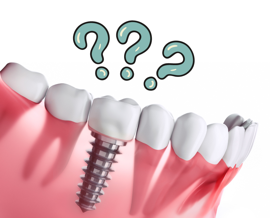 Cos’è un impianto dentale e quando è necessario
