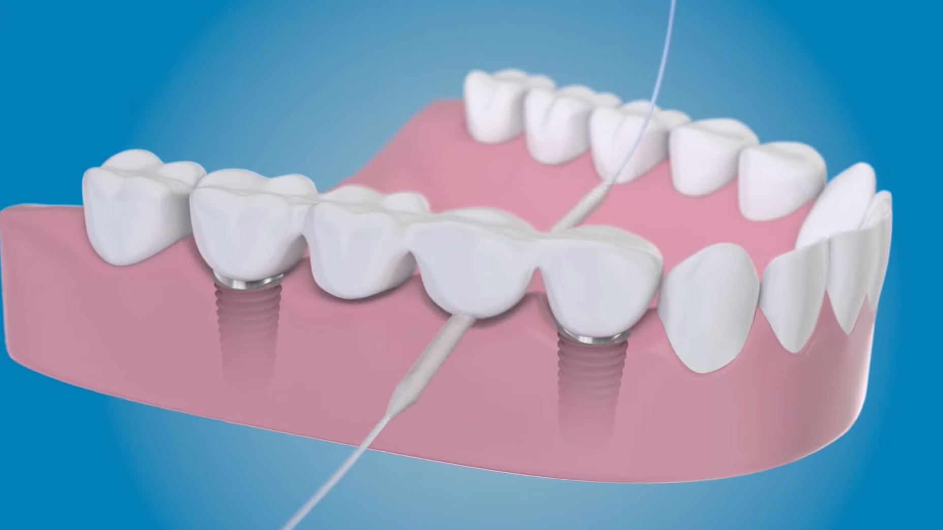 Posso usare il filo interdentale se ho corone o ponti dentali?