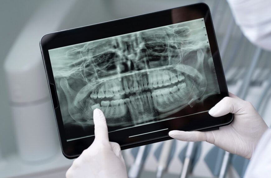 Quando viene consigliata la radiografia panoramica (OPT)?
