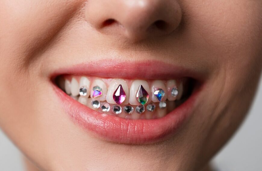 Brillantino dentale: può danneggiare i tuoi denti?