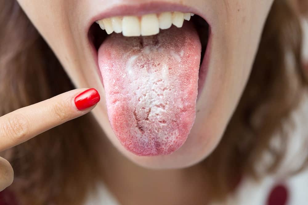 Perché ho la lingua bianca?