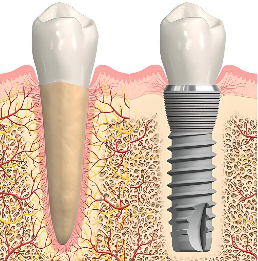 Analogie e differenze tra Dente Naturale e Impianto Dentale