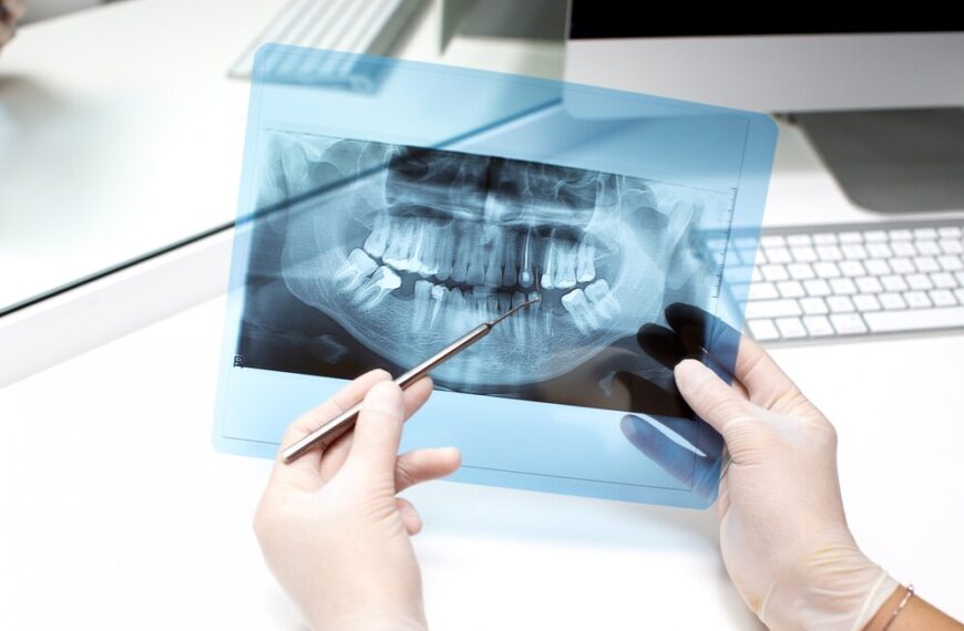 Di quanti impianti dentali avrò bisogno per sostituire i miei denti mancanti?