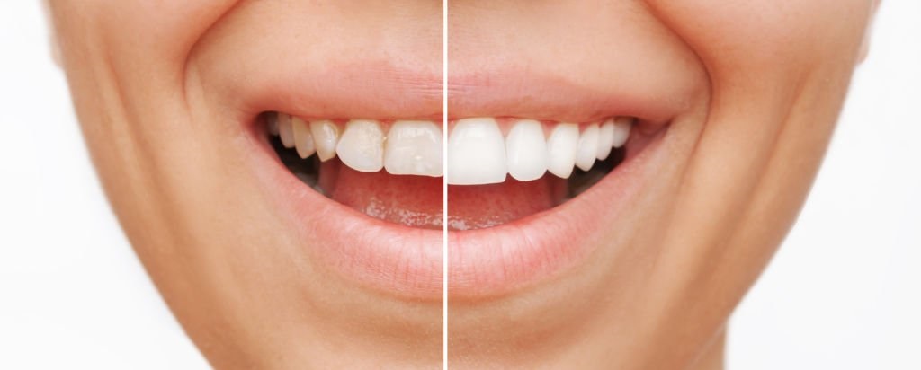 Cosa sono le faccette dentali e come funzionano?