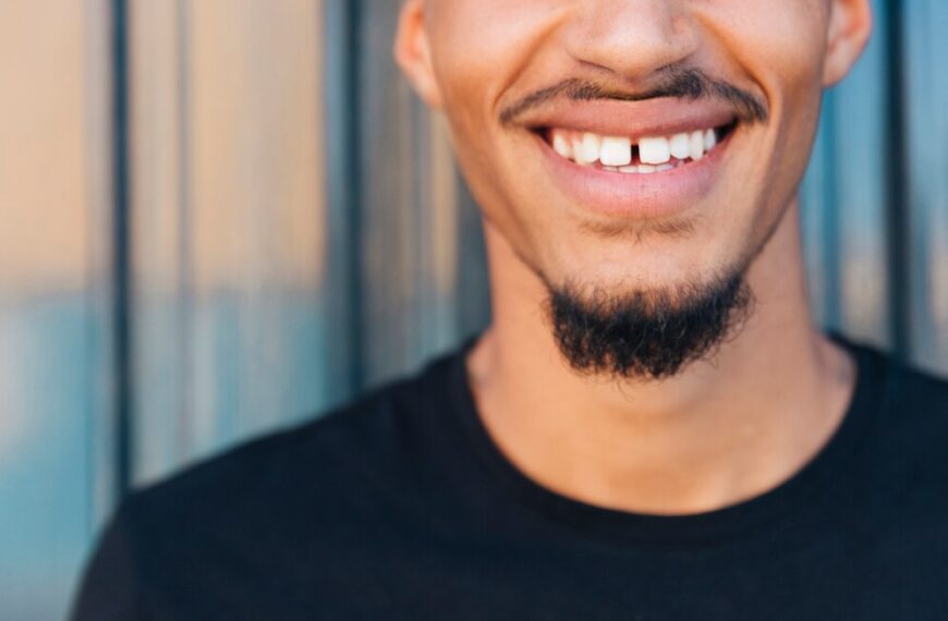 Quali Sono le Opzioni di Trattamento per il Diastema Dentale?