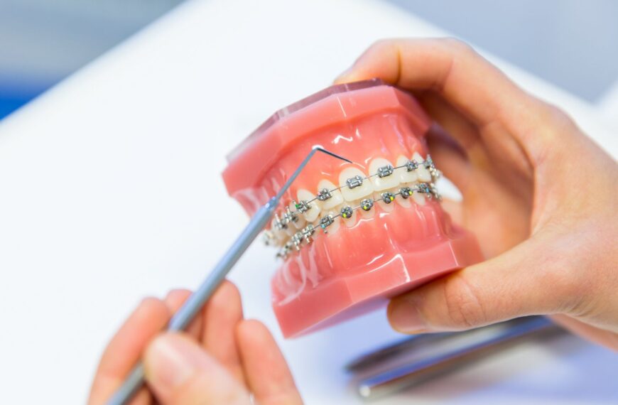 Che tipo di apparecchio ortodontico è più adatto a me?
