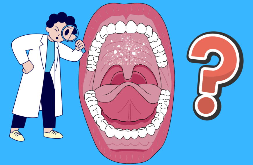 Macchie Bianche sul Palato: potrebbe essere Candida?