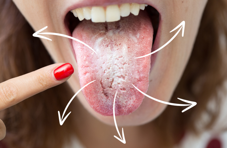 Candida orale: è contagiosa?