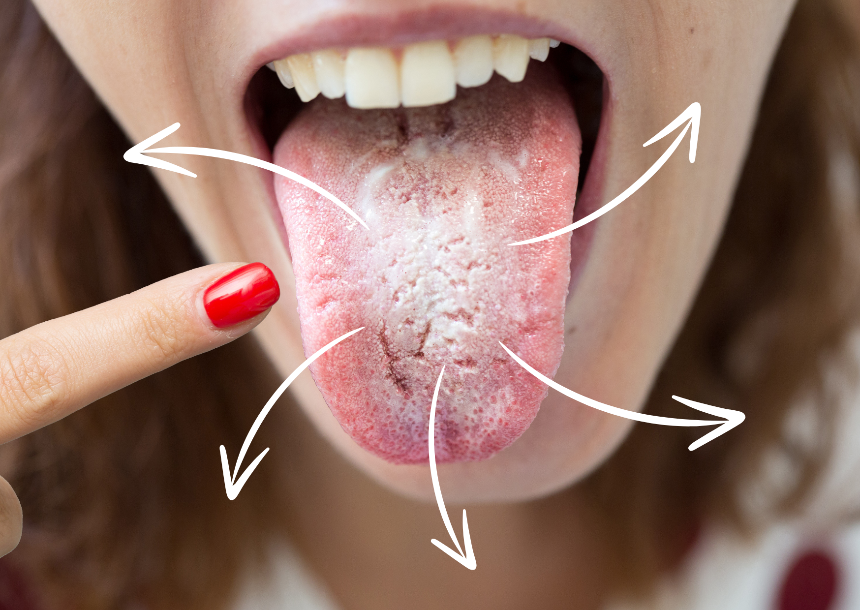 Candida orale: è contagiosa?