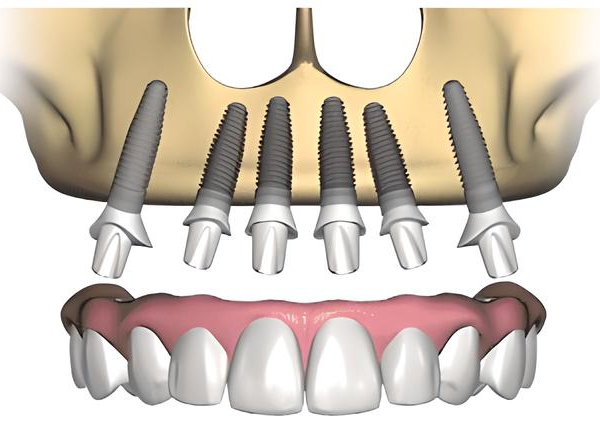 Il dentista mi ha proposto un “Full-arch”: cos’è?