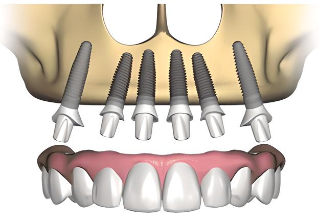 Il dentista mi ha proposto un “Full-arch”: cos’è?